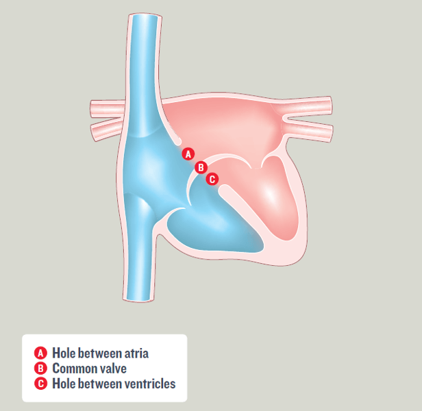Atrioventricular Septal Defect (AVSD)