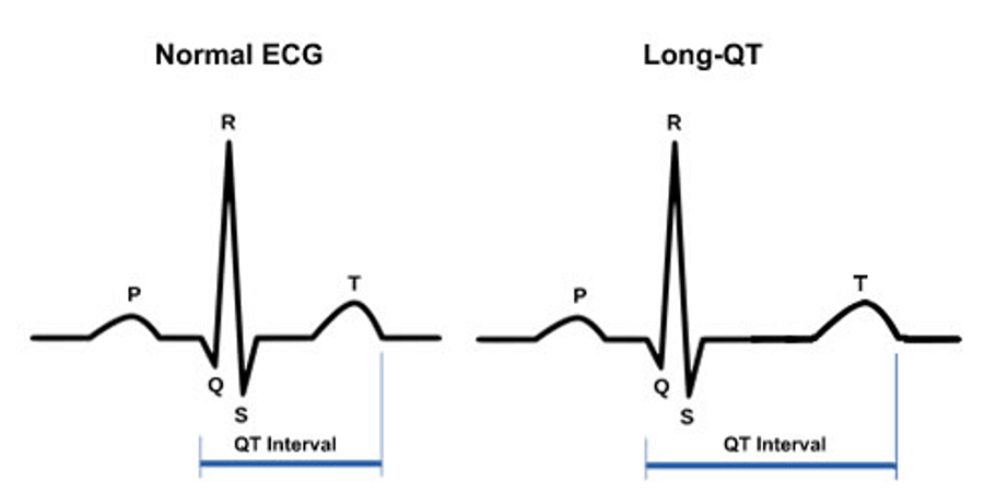 Long QT Syndrome