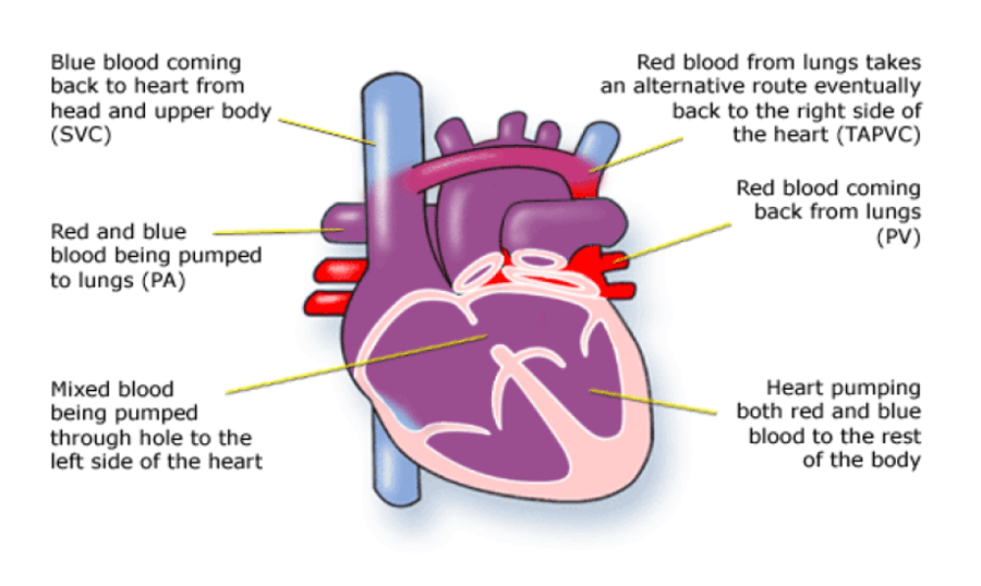Anomalous Pulmonary Venous Drainage (TAPVD, PAPVD)
